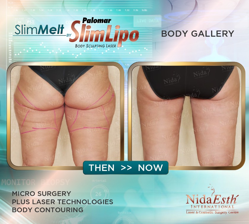 liposuction-slim-bkk-3