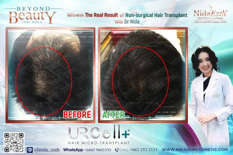 Cellular hair transplant for more natural, healthier & thicker hair