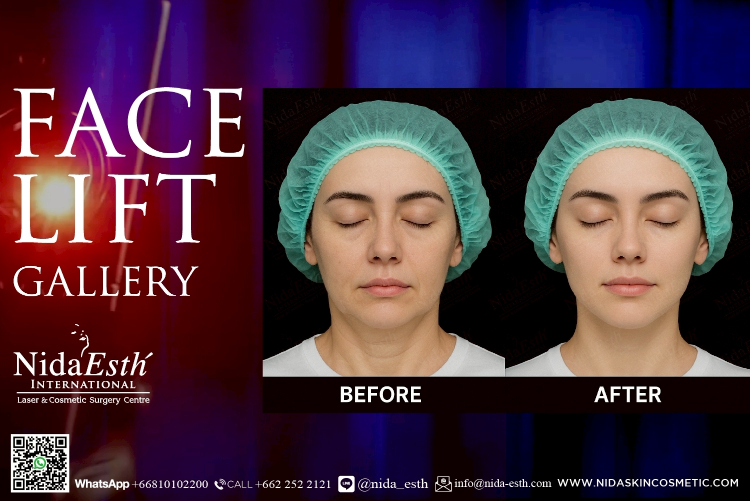 Before After Infinity LiftX