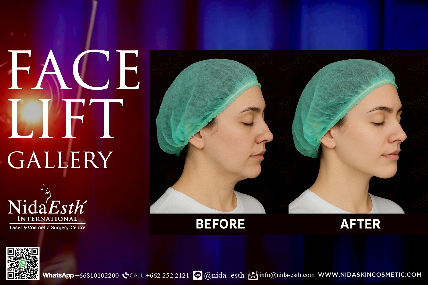 Before After Infinity LiftX